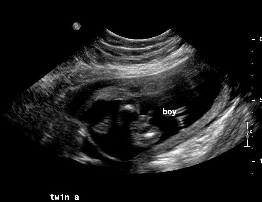 So, we're having a hermaphrodite??!!! US help please! BabyCenter